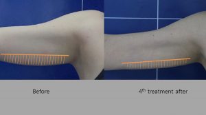 Before and After HIFU Results on arms