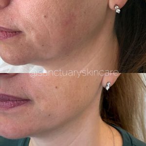 Sydney HIFU Treatment Client Before and After Results