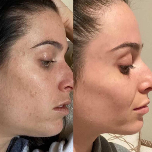 Skin client Emma's before and after treatments