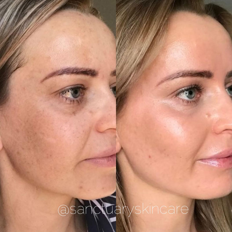Woman Cosmelan treatment before and after photo